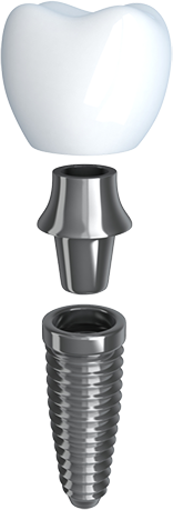 A Diagram of dental implants